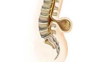 Myelomeningocele