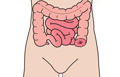 Colostomy