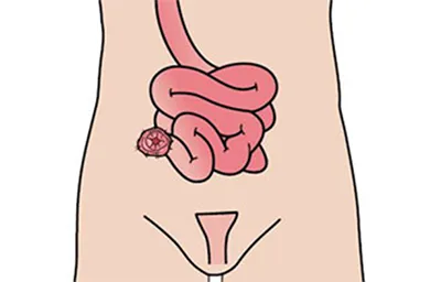 Ileostomy