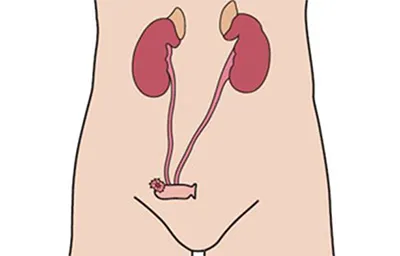 Urostomy
